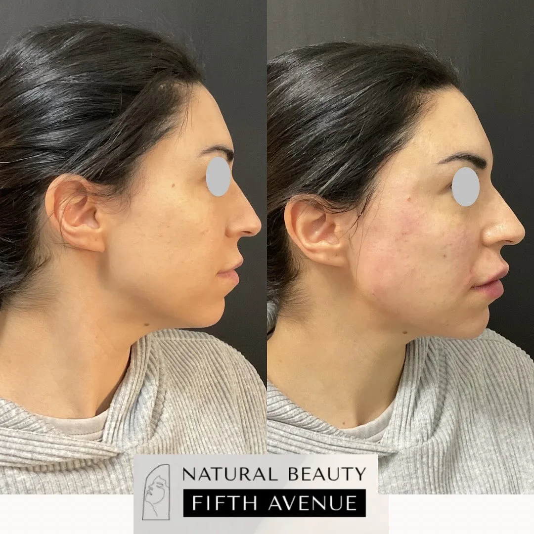 Before and after side profile comparison of dermal filler treatment for facial volume at Natural Beauty Fifth Avenue